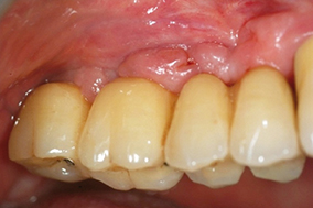 5 & 6 - Amélioration de l’état gingival péri-implantaire obtenue après modification de la structure de contact muqueux permettant l’utilisation efficace de brossettes.