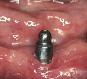 7 & 8 - Suppression de l’inflammation péri-implantaire par une augmentation de la hauteur de muqueuse « attachée » kératinisée obtenue par greffe.