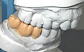 1 - Analyse préimplantaire à l’aide d’un Wax-Up (praticien maître d’œuvre de la prothèse).