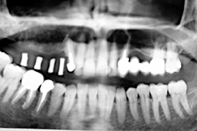 2 - Analyse préimplantaire à l’aide d’un cliché radiographique panoramique (praticien maître d’œuvre de la prothèse).