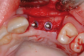 5 - Pose implants (praticienchirurgien).