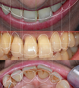 Protocole Digital Smile Design 2