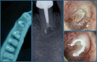 Chirurgie endodontique ; le continuum de l’endodontie