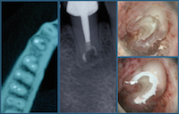 Chirurgie endodontique ; le continuum de l’endodontie