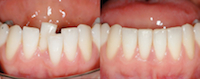 Choix thérapeutiques du secteur incisif mandibulaire chez l’adulte : considérations orthodontiques et parodontales
