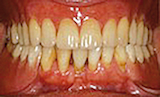 3 : Fermeture d’une brèche d’édentement encastrée pour permettre la construction d’un appareillage prothétique plus simple et moins étendu. Cette modification de classe améliore l’équilibre mécanique ainsi que l’esthétique du secteur antérieur.