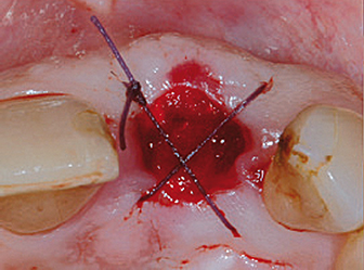 photo clinique 1 : post extraction et suture