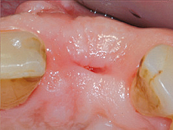 photo clinique 2 : controle post extraction