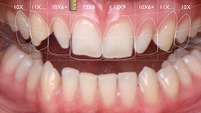 Protocole Digital Smile Design 1