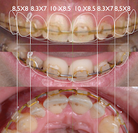 3 - DSD et aide aux traitements orthodontiques - Renaud Noharet ADF 2015