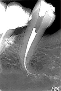 TP 11 - Endodontie 2