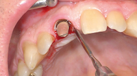 Utilisation du périotome (Friatec®) tangentiellement à l’axe de la racine, à l’aide d’un maillet.