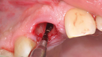 Détermination du futur axe d’insertion de l’implant en prenant appui au niveau de la paroi palatine.