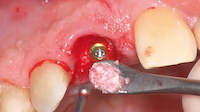 Insertion Bio-Oss® hydraté au niveau du hiatus vestibulaire, pilier de cicatrisation en place.