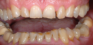 Fig.1 Exemple d’usures dentaires dues à l’attrition, à l’abrasion et à l’érosion accentuées par un bruxisme d’éveil.