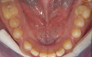 Fig.2 Contrôle des contacts occlusaux après collage des éléments prothétiques.