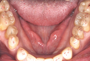 Fig.3 Préparations pour overlays dans le cadre d’une restauration occlusale. La DVO est déterminée par les composites temporaires collés sur les incisives mandibulaires.