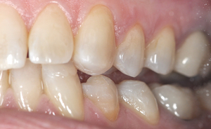 1. Exemple clinique après équilibration, les contacts occlusaux étaient insuffisant au niveau des dents cuspidées. Contrôle de l’épaisseur dévolue au matériau pour respecter les contraintes physiques imposées par la céramique. 