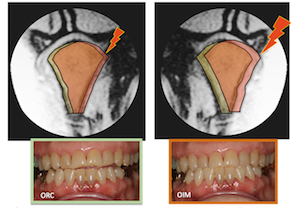 L’équilibre des structures musculo-articulaires doit correspondre à un équilibre orthopédique des arcades dentaires (J. Okeson).