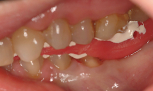 figure 3 - Reconstruire les fonctions occlusales