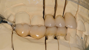 figure 9 - Reconstruire les fonctions occlusales