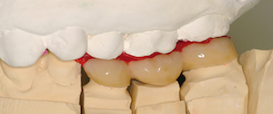 Figure 5 - Reconstruire les fonctions occlusales