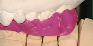 figure 6 - Reconstruire les fonctions occlusales