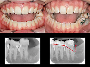 figure 1 - Que faire avec des mini-vis en orthodontie ?