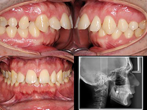 figure 2 - Que faire avec des mini-vis en orthodontie ?
