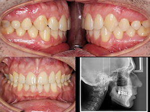 figure 3 - Que faire avec des mini-vis en orthodontie ?
