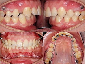 figure 4 - Que faire avec des mini-vis en orthodontie ?