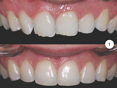 figure 1 - Catherine Galletti : Supraculsion