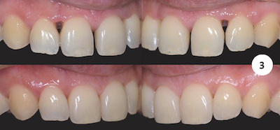 figure 3 - Catherine Galletti : effondrement des papilles