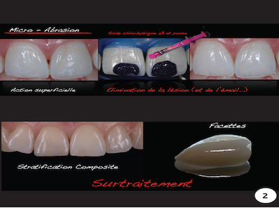 figure 2 - Anthony Atlan : technique d’érosion-infiltration