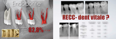 figure 1 - Olivier Etienne : RECC-dent vitale