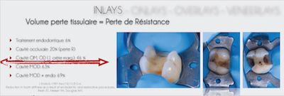 figure 3 - Olivier Etienne : La perte de résistance de la dent 