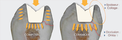 figure 4 - Olivier Etienne : La fracture cuspidienne