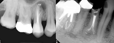 illustration 4 recherche d’une étanchéité endodontique Dr Bronnec