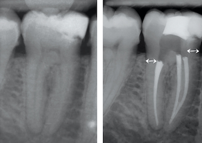 illustration 2 dent dévitalisée par rapport à une dent vitale Dr Drossart