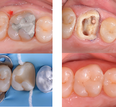illustration 4 assurer la pérennité de la dent Dr Drossart