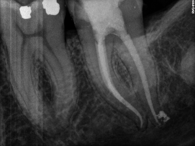 TP 8 - Endodontie Système Wave One Gold