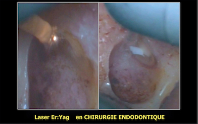 En chirurgie endodontique le laser Er-YAG va nous permettre d’éliminer les tissus granulomateux, kystiques, et assurer un débridement optimal de la crypte osseuse 