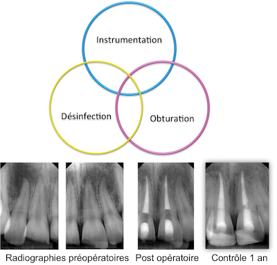 Les trois étapes essentielles à la réussite d’un traitement endodontique sont la mise en forme, la désinfection et l‘obturation canalaire