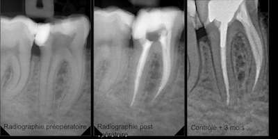 L’utilisation des biocéramiques (ici BioRootTMRCS, Septodont, Saint-Maur-des-Fossés) au cours de l’étape de l’obturation canalaire s’avère une solution simple et efficace