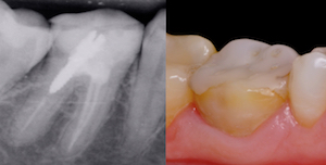 1 - Radiographie et aspect clinique préopératoire. 