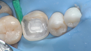 3 - Après reprise endodontique, dépose de l’ensemble du CVI périphérique. Son aspect est discernable après séchage. Un coin de bois protège la digue.