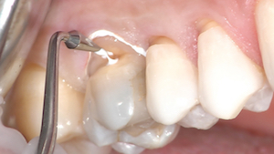1 - Les lésions cervicales peuvent être isolées de différentes manières. Une lésion juxta- ou légèrement sous-gingivale, avec présence de gencive et un sulcus suffisant pourra être isolée par l’association d’un écarteur automatique (Optragate®), d’absorbants salivaires (Dry tips®), de Téflon® dans le sulcus et de composite autoadhésif dans les embrasures palatines. Le Téflon® doit être mis en place de la zone proximale distale à la zone proximale mésiale pour repousser les fluides sulculaires en palatin.