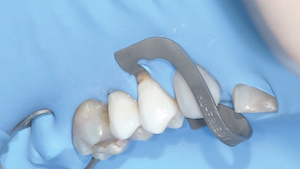 3 - Après mordançage à l’acide orthophosphorique au niveau de l’émail uniquement, un système adhésif automordançant en 2 temps (optibond XTR®) est utilisé. Une couche de composite flow est d’abord appliquée puis photopolymérisée. La restauration est terminée à l’aide de composite.