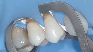 4 - Lorsque la lésion est largement sous gingivale, ou qu’il n’y a pas de gencive en cervical, une isolation par une digue latex est utilisée. Des clamps additionnels sont utilisés pour repousser la digue au-delà de la limite cervicale. L’accès au-delà des limites est primordial.