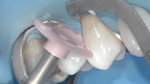 6 - Après réalisation des biseaux et mordançage amélaire, le comblement de la lésion est effectué classiquement à l’aide d’un système adhésif mordançage rincage en 3 temps (Optibond FL®) et de composite, mis en forme à l’aide d’un pinceau. Un prépolissage est effectué à l’aide de pointes silicones diamantées.